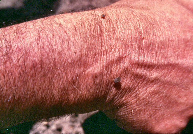 Argasids' lesions copy