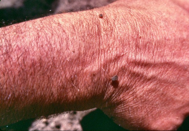 Argasids' lesions copy